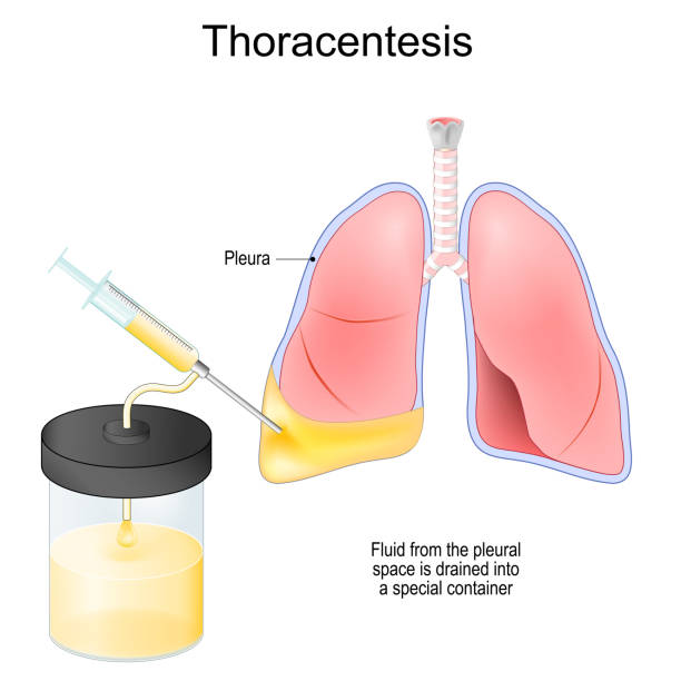 Clinicer | Торакоцентез и плевроцентез: Важные аспекты диагностических процедур